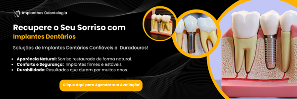 Imagem de Banner de Conversão para um posto no Blog Implanthos sobre Implante Dentário