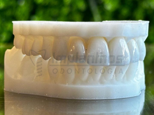 Imagem das lentes de contato dental da paciente paula clínica odontológica implanthos