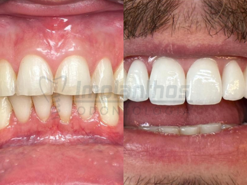 Imagem do Sorriso de um paciente Homem de Antes e Depois de Lente de Contato Dental em Guarapuava