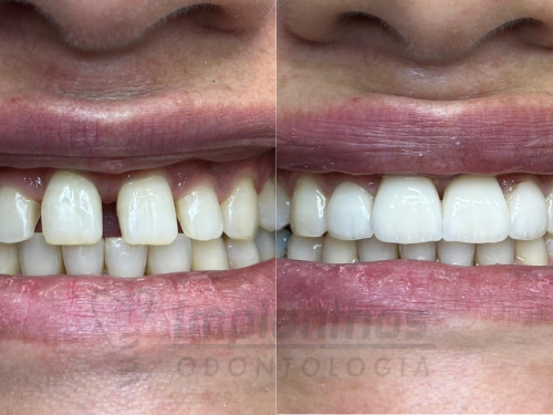 Imagem do sorriso antes e depois da paciente Luciane colocar as facetas dentárias